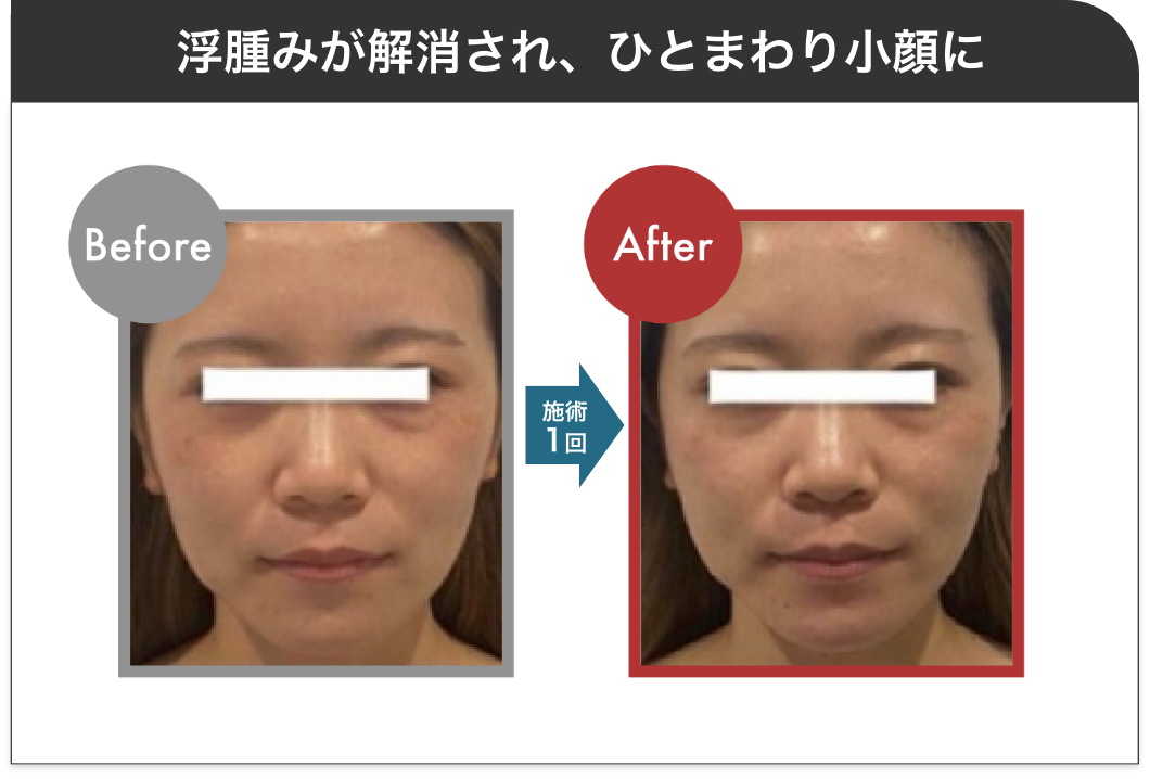 むくみが解消され、ひとまわり小さい小顔に